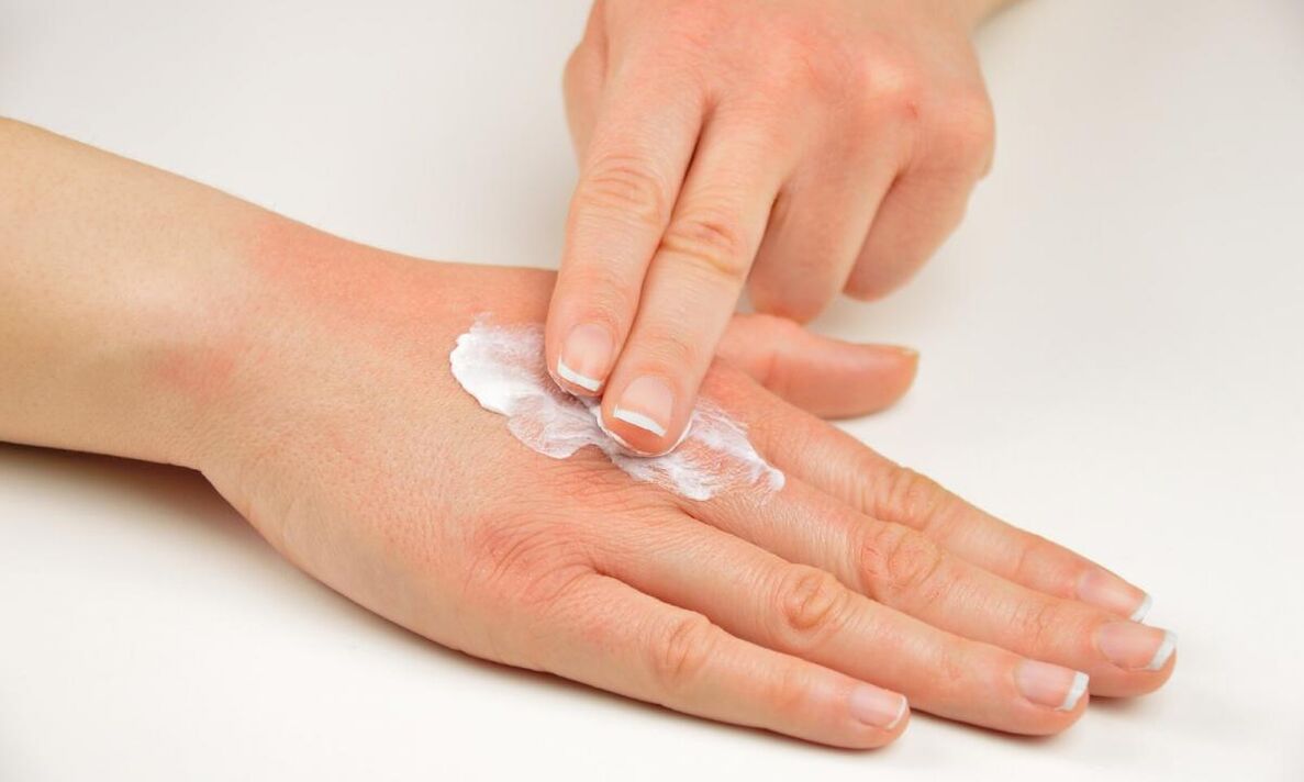 Psoriasis-Behandlung mit Keramin-Creme