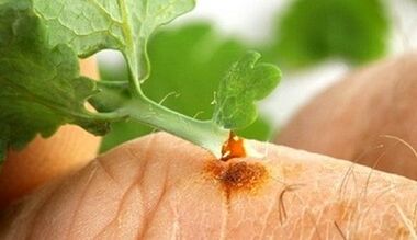 Wie man eine Warze mit einem Celandine bekommt