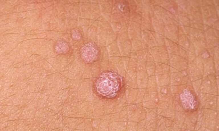 HPV führt zum Auftreten von Hautpapillomen