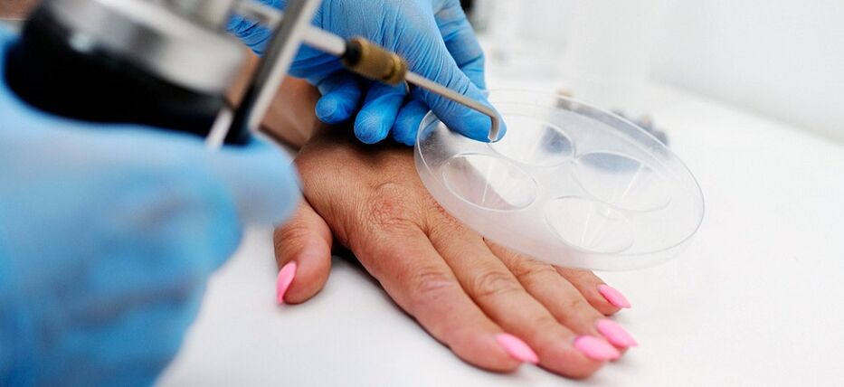 Professionelle Warzenentfernung zur Hand
