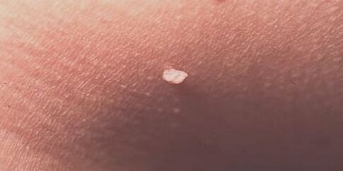 Humanes Papillomavirus auf der Haut