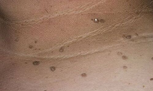Manifestationen des humanen Papillomavirus