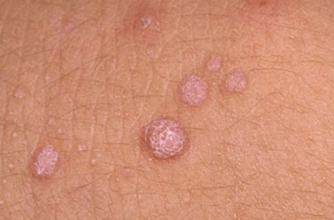 Symptome des humanen Papillomavirus
