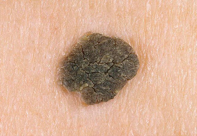 Warze auf der Haut