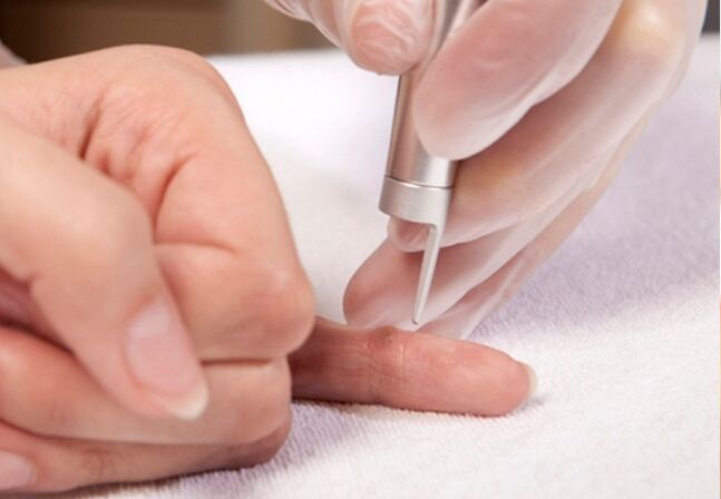 Warzenentfernung am Finger