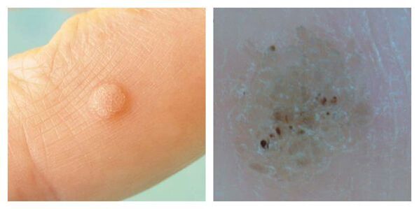 Gewöhnliche Warzen während der Untersuchung und Dermatoskopie