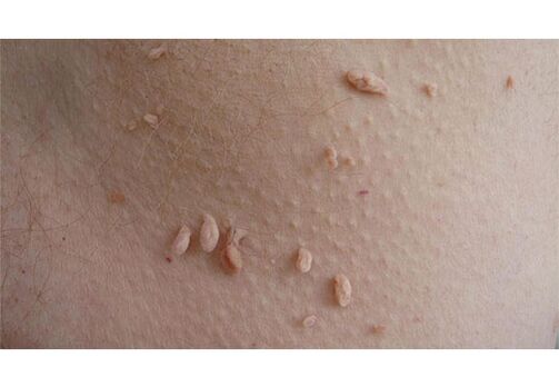 Ein Zeichen einer HPV-Infektion ist das Auftreten von Papillomen am Körper