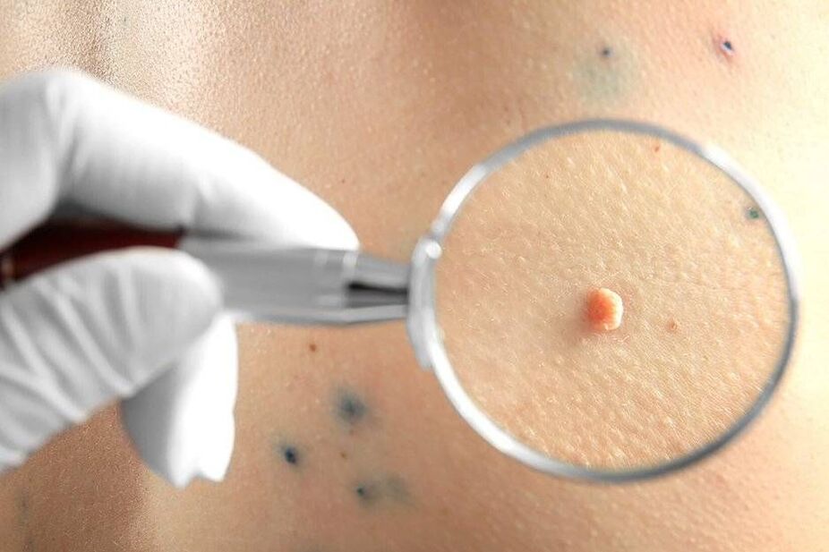 HPV-Behandlung