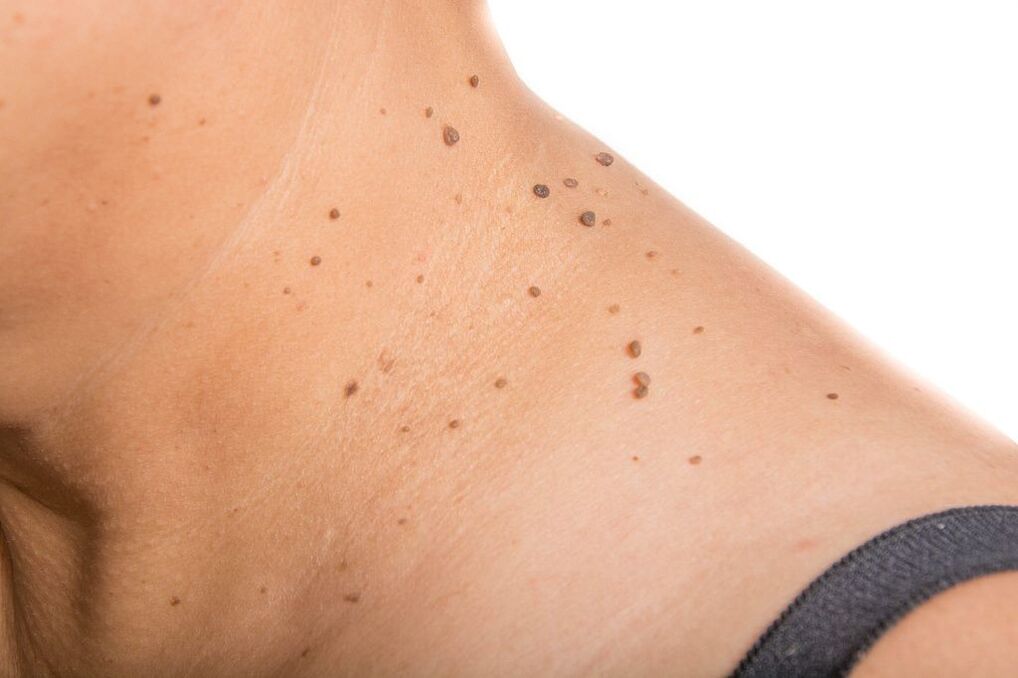 Komplikationen von HPV